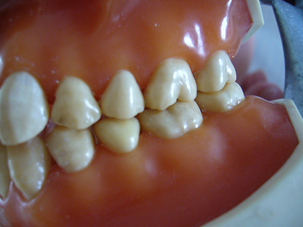 正常な歯の歯頸部