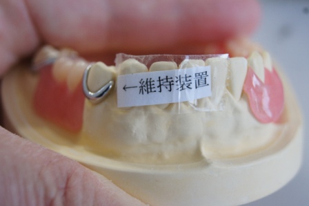 部分入れ歯の鉤歯